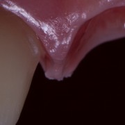 Soft tissue management