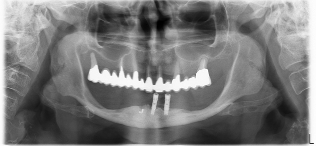 Mandibola atrofica Formazione Odontoiatrica 2