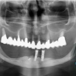 Mandibola atrofica all on 4 formazione odontoiatrica