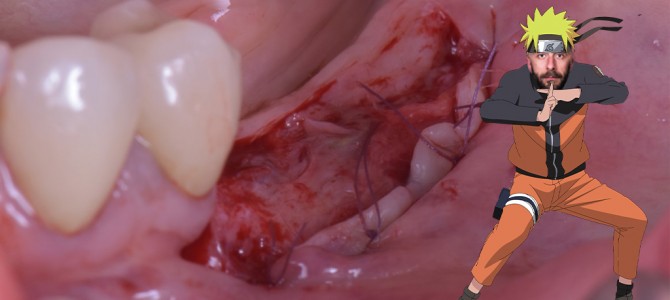 [video] Free gingival graft technique in the posterior mandible. Chapter 1: Preparation of the recipient site